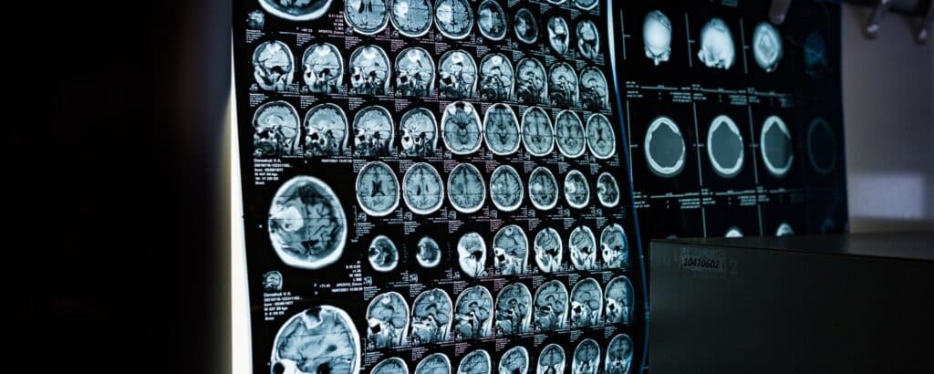 How Esketamine Works in the Brain